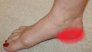 Біль в п’яті. П'яткова шпора, фасциїт. Метод лікування - радіочастотна денервація. фото